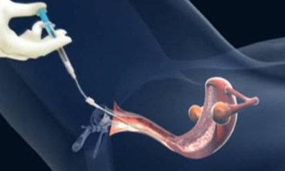 岳阳试管婴儿医院优选指南，排名前五机构均可选择